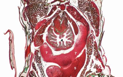Tout savoir concernant le cancer de l’œsophage